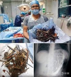 胃里开五金店?43岁女子腹痛就医 手术取出物惊呆医生