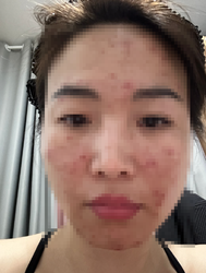 欣玥国际调理痘痘和眉眼唇被骗