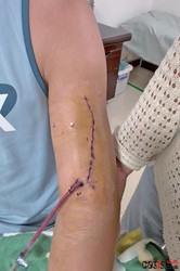 和游客掰了个手腕，22岁演员左臂骨折，景区、中介、传媒公司谁该负责？